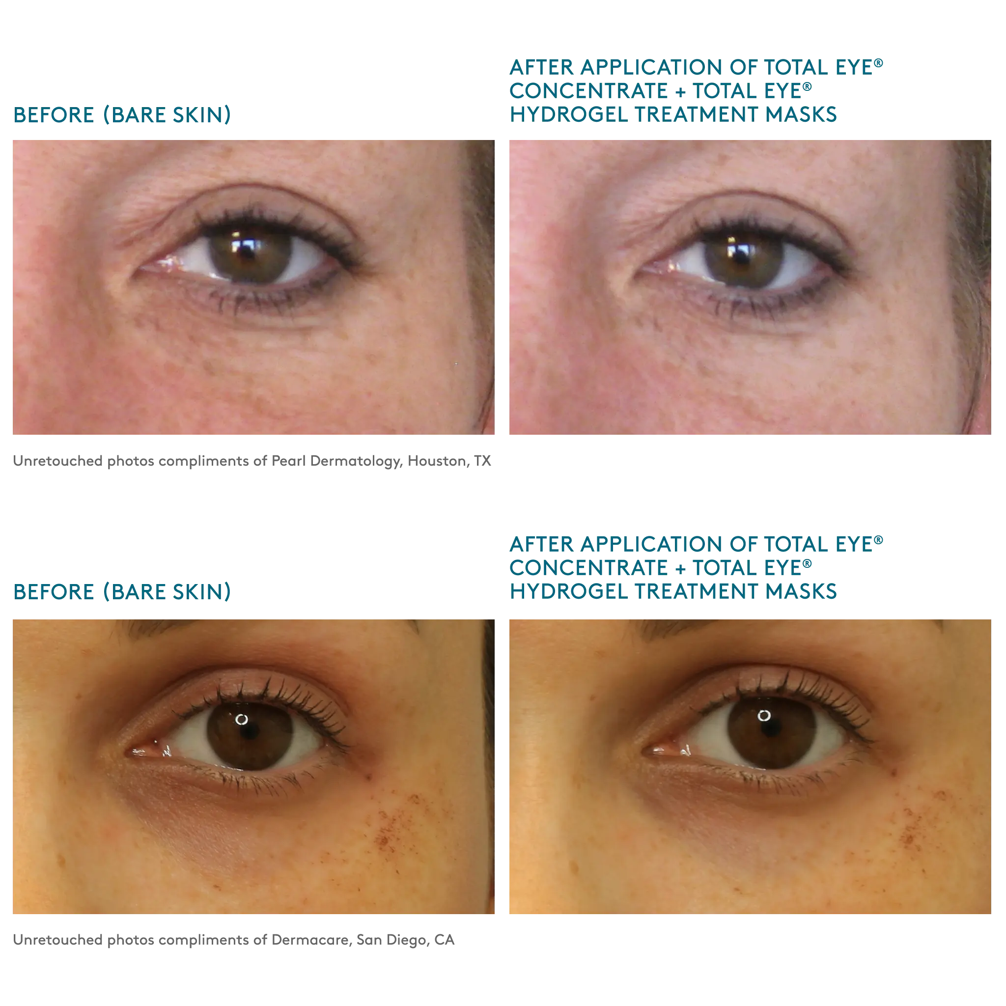 unretouched before and after images after using Total Eye Hydrogel Treatment Masks and Concentrate Serum || all